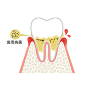 歯肉が赤く腫れ、歯を磨くと出血する場合もあります。