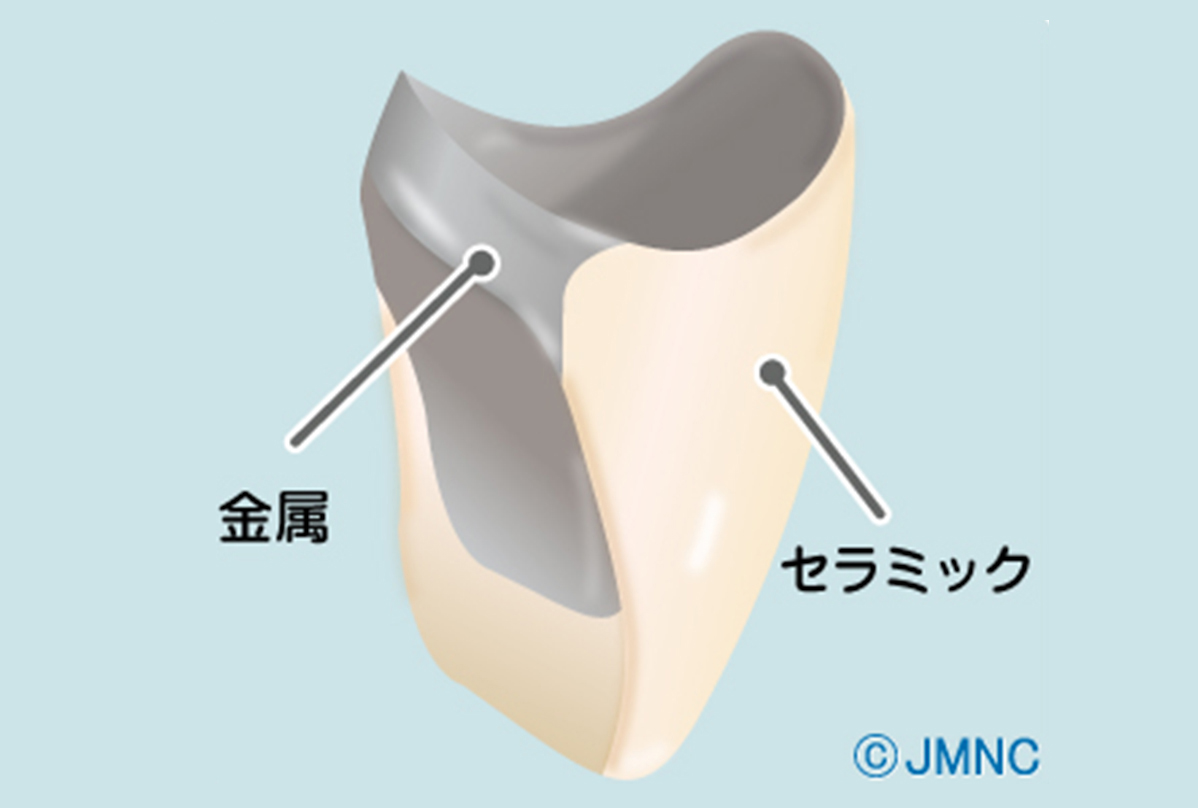 メタルボンドクラウン