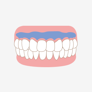 歯肉に専用の薬剤を塗布。一時的に歯肉が白くなります。