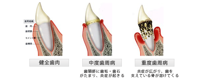 歯石ってどうしてとらないとならないの？