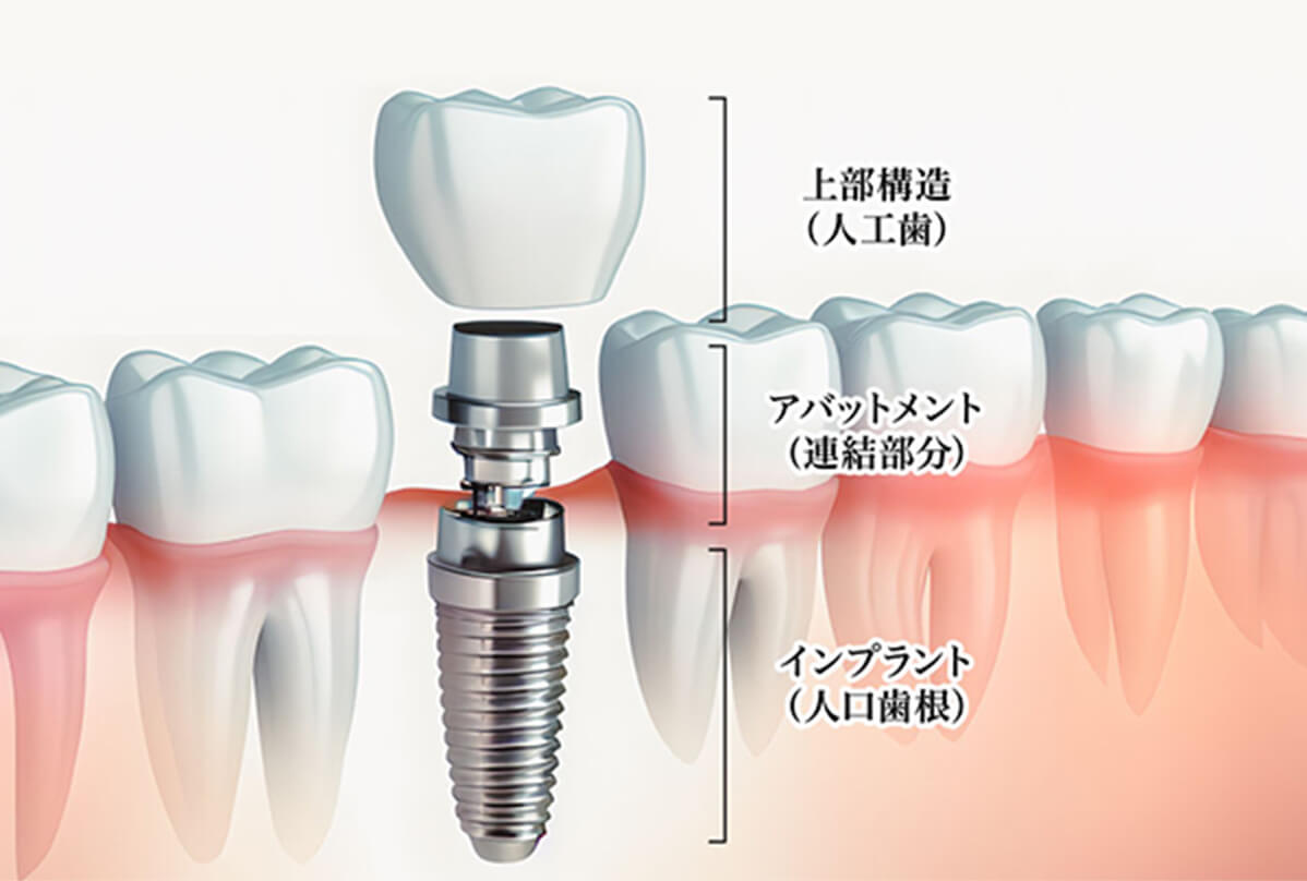 失った歯を取り戻し、健康で自信のある口元へ