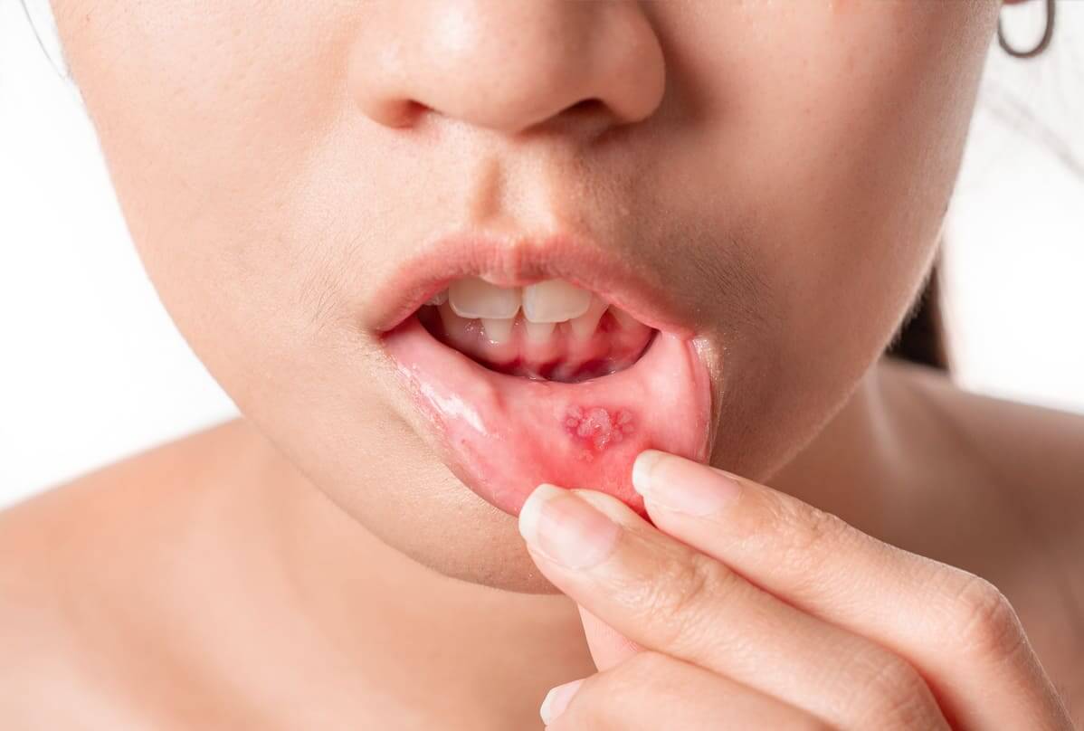 口内炎・粘膜のトラブル