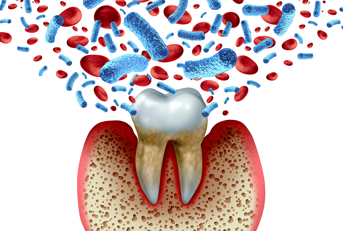 歯周病とは