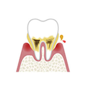 歯肉が赤紫色に腫れ、口臭がひどくなります。