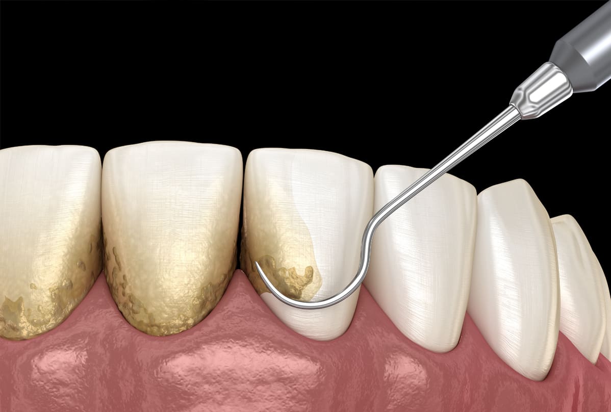 歯石除去（スケーリング/ルートプレーニング）